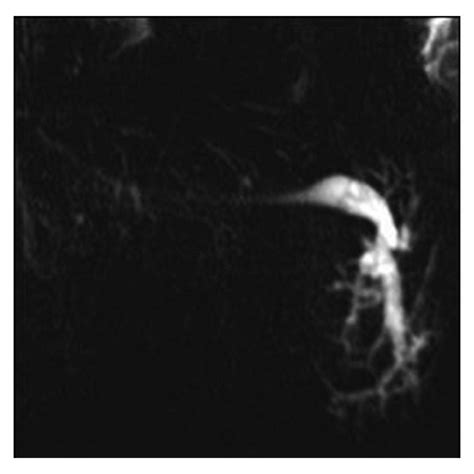 Ducts Of Rivinus Crossing The Main Submandibular Gland Duct Vertically