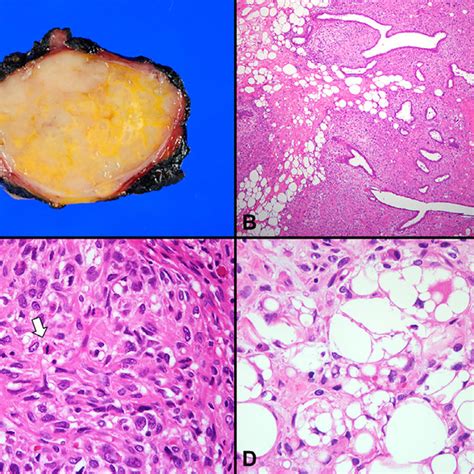 Pdf Malignant Phyllodes Tumor Of The Breast With Liposarcomatous