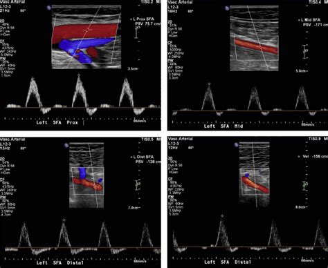 Lower Extremity Venous Doppler Waveforms