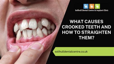 What Causes Crooked Teeth And How To Straighten Them