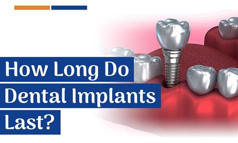 How Long Do Dental Implants Last