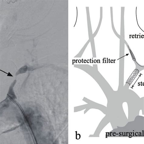 The arrow indicates the stenosed segment of the subclavian artery (a ...