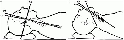 Obtaining a Surgical Airway | Anesthesia Key