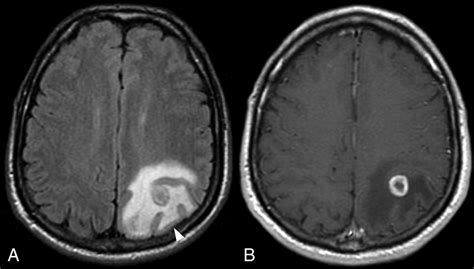 Brain Tumor Mri Without Contrast