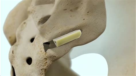 Ifuse Intra™ Allograft Implant System Animation Youtube