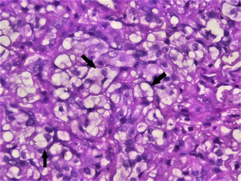 Scielo Brasil Clear Cell Variant Of Oral Squamous Cell Carcinoma