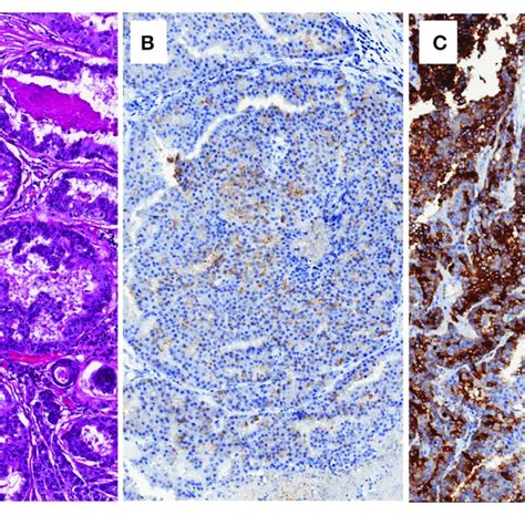 | Brain metastasis of prostate cancer with cribriform pattern (A ...