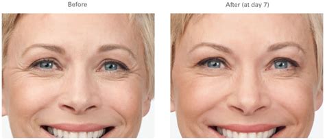 Botox Crows Feet Before And After Galleries Pictures Long Beach