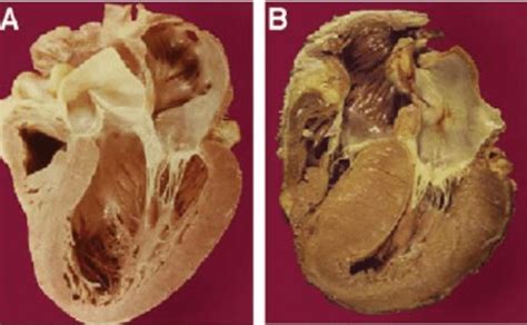 Cardiac Hypertrophy And Heart Failure