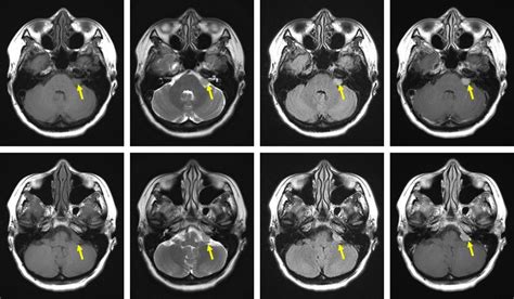 CPA meningioma – Radiology Cases