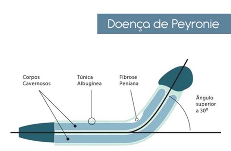 Doença De Peyronie Você Sabe O Que é Dr Paulo Esteves