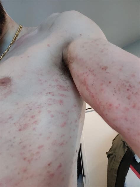 Any Ideas What Caused This Rash R Dermatologyquestions