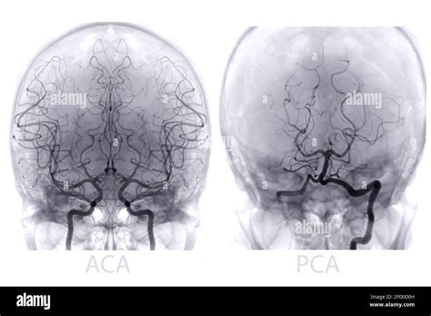 Imagen De Angiograf A Cerebral De La Fluoroscopia En Radiolog A De