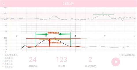 胎心监护图怎么看宫缩呢？ 知乎