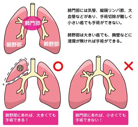 肺がんの治療・手術 新横浜かとうクリニック