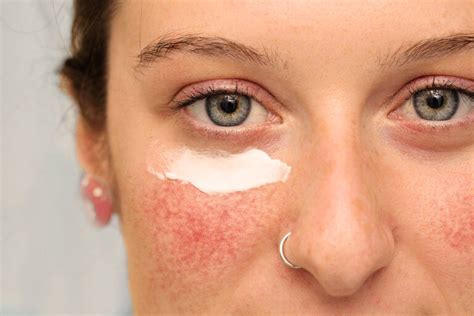 Rosacea Ursachen Symptome Behandlung Sanubiom