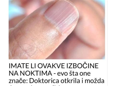 IMATE LI OVAKVE IZBOČINE NA NOKTIMA Evo Šta One Znače Doktorica