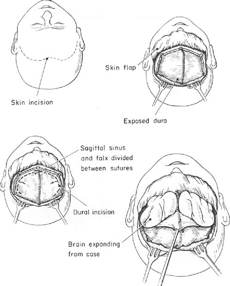 Pdf Bifrontal Decompressive Craniotomy For Massive Cerebral Edema Semantic Scholar