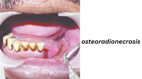 Osteoradionecrosis Radiotherapy Edutech Radiotherapy Side Effects