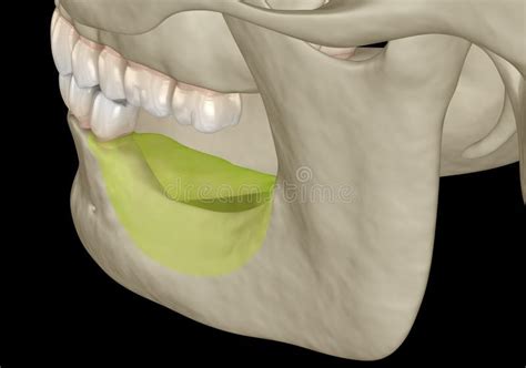 Mandibular Jaw Bone Recession After Losing Molars Teeth Medically