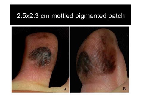 Acral Lentiginous Malignant Melanoma