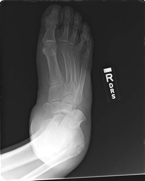 X Ray Of Fracture Foot at Victor Easley blog