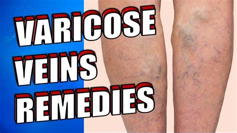 7 Natural Ways To Treat Varicose Veins At Home Easily Youtube