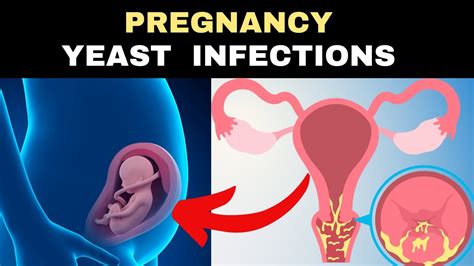 Sensational Info About How To Cure Yeast Infection During Pregnancy