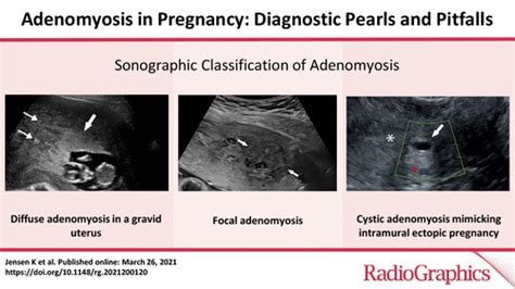 Adenomyosis In Pregnancy Diagnostic Pearls And Pitfalls Radiographics