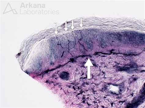 Nerve Fibers In Skin Biopsy Neuro Notes By Dr Wilson