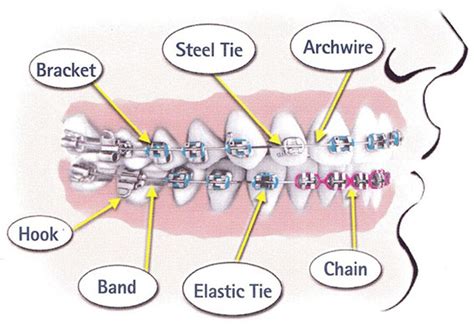 Braces Diagram Clearview Orthodontics Braces And Invisalign