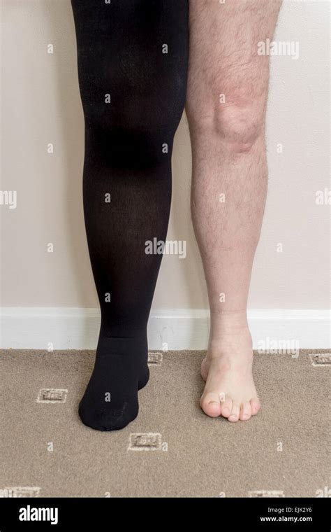 Male with lymphedema in right leg wearing compression stocking Stock ...