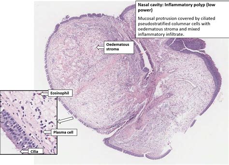 Nasal Tissue Polyp Nus Pathweb Nus Pathweb