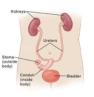 Incontinent Urinary Diversion | Saint Luke's Health System