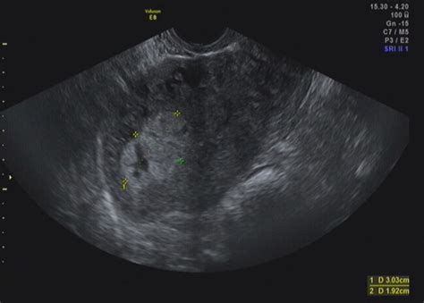 The Gray Scale Ultrasound Image Of A Year Old Woman Gravida Para