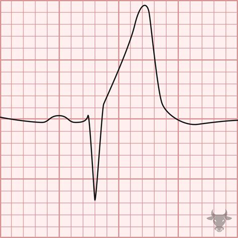 Hyperacute T Waves Ecg Stampede