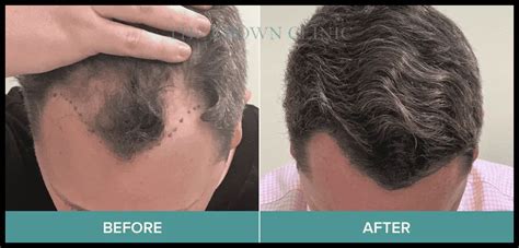 Expert Fue Hair Transplant Sydney Hairs For Only