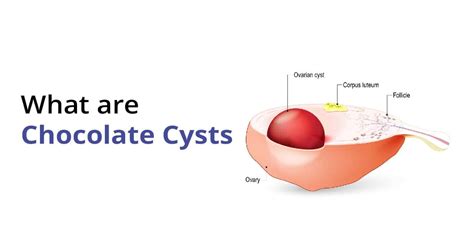 Symptoms Of Endometrial Cyst