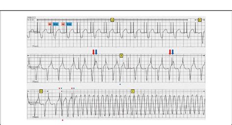 Figure Electrocardiogram During Atrial Capture Management Acm