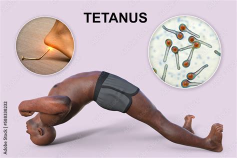 A 3D Medical Illustration Of A Black Skinned Man Suffering From Tetanus