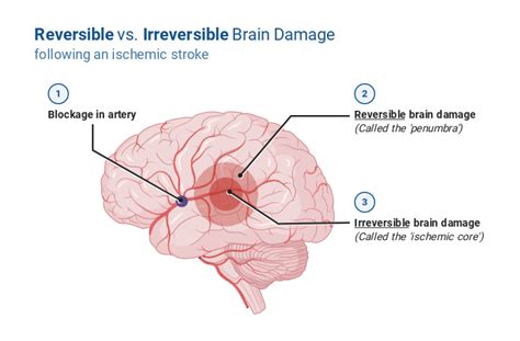 Reversible vs. Irreversible Brain Damage Following an Ischemic Stroke ...