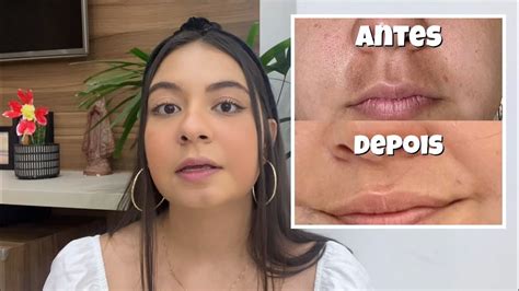 Como Clarear Mancha Do Rosto De Espinha De Limão Melasma Qual