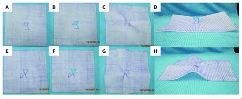 Comparison Of Limberg Flap And Triangular Flap Technique On A 6060 Cm