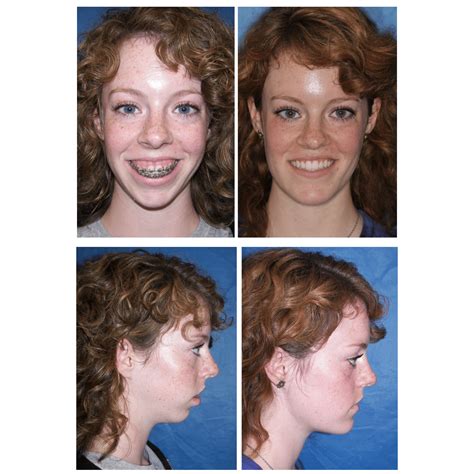 Jaw Surgery For Tmj Before And After