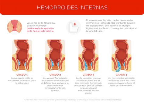 Tipos De Hemorroides Grados Y S Ntomas The Best Porn Website