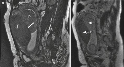 Mri Of The Placenta Radiology Key