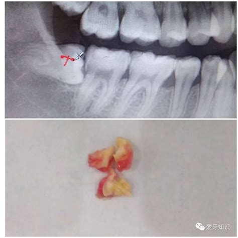 横着长的智齿一定要拔掉吗看完你就明白了 腾讯新闻