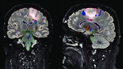 Preoperative T2 FLAIR Magnetic Resonance Imaging MRI Scan In Coronal