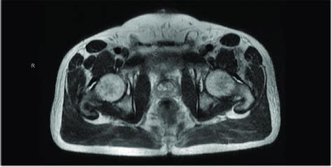 Magnetic Resonance Imaging Confirming A Solid Lesion In The Wall Of The