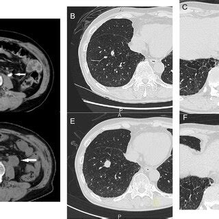 Contrast Enhanced Computed Tomographic Image At The First Visit A The